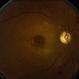 Macular Infarction in Systemic Lupus Erythematosus Macular Infarction in Systemic Lupus Erythematosus
